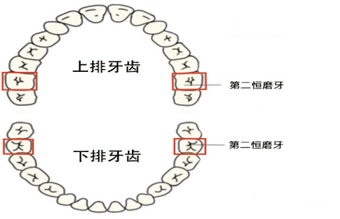 圖3 第一恆磨牙位置第二次為第一恆磨牙窩溝封閉的最佳時間,第一恆