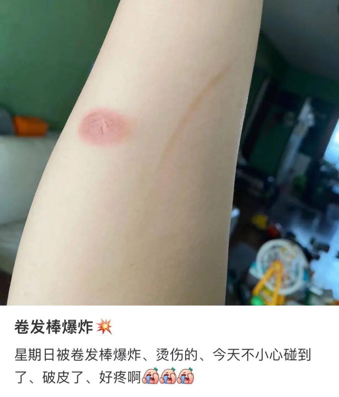 女生胳膊烫伤照片图片