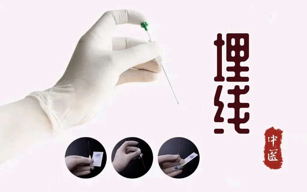 穴位埋线原理中医院针灸三科中医埋线减肥法火热进行中