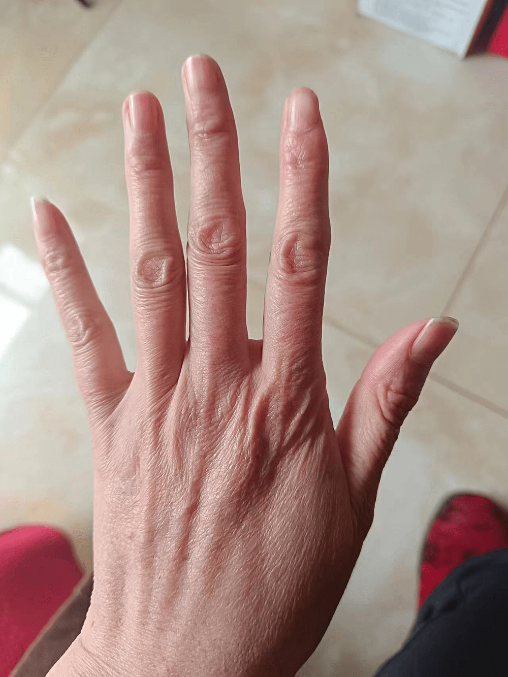 这是我人生中第一次听说"马凡综合征".