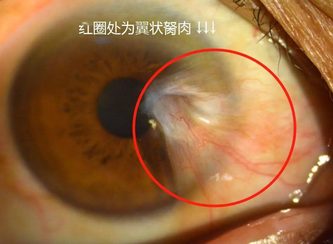 翼状胬肉基本概念图片