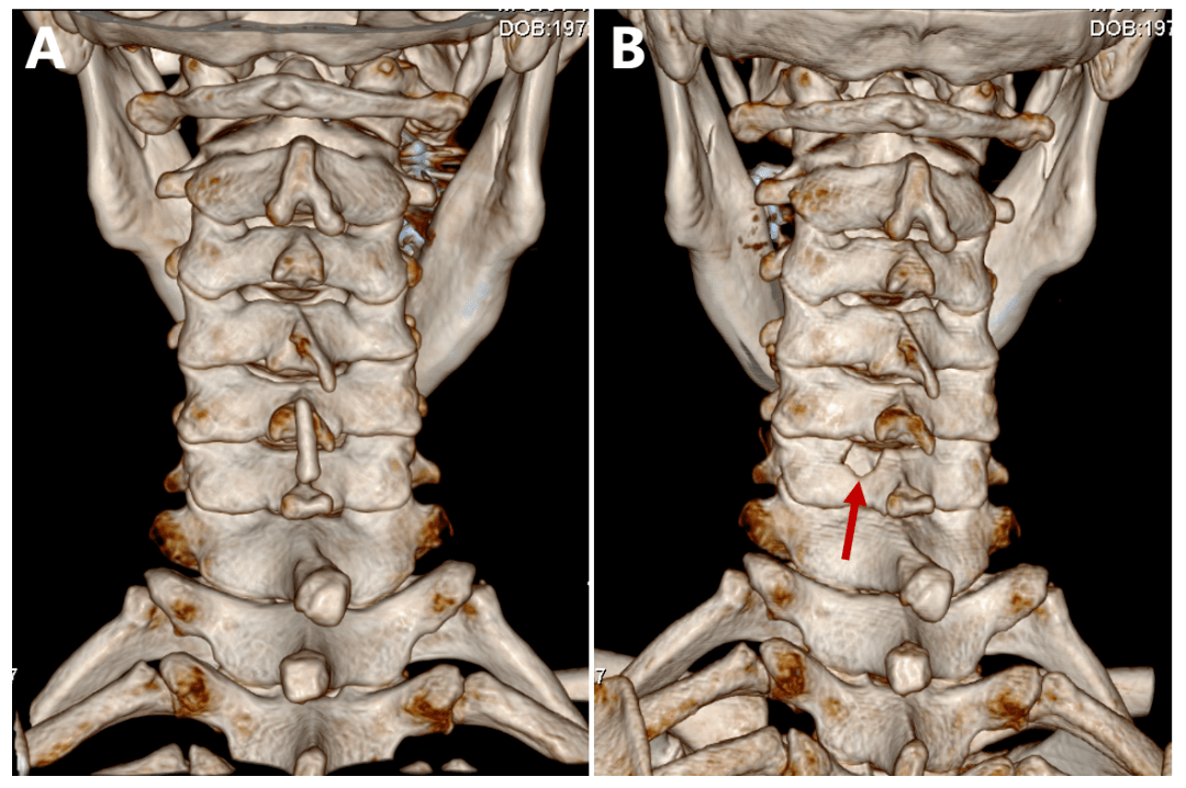 术后颈椎mri(a