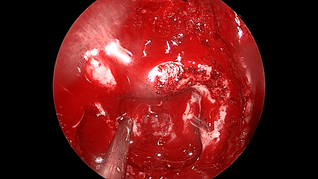 【病例分享】充满悬念的探漏之旅 —— 自发性脑脊液鼻漏一例_骨质