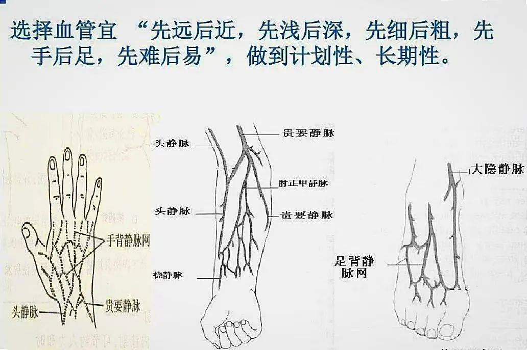 血管旁侧进针示意图图片