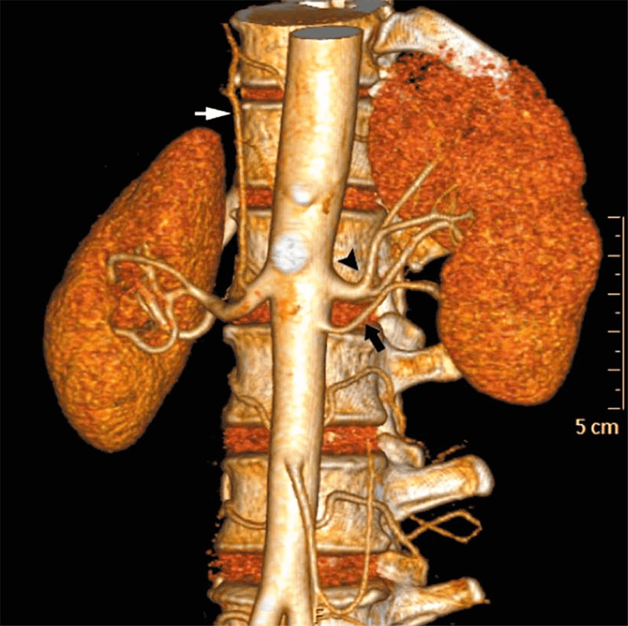 副肾动脉 accessory renal artery_血管_起始_左主
