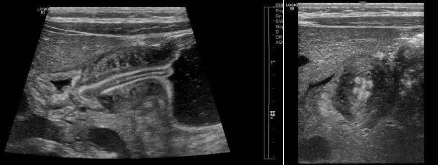 超过上述正常值的情况就可以诊断为肥厚性幽门梗阻.