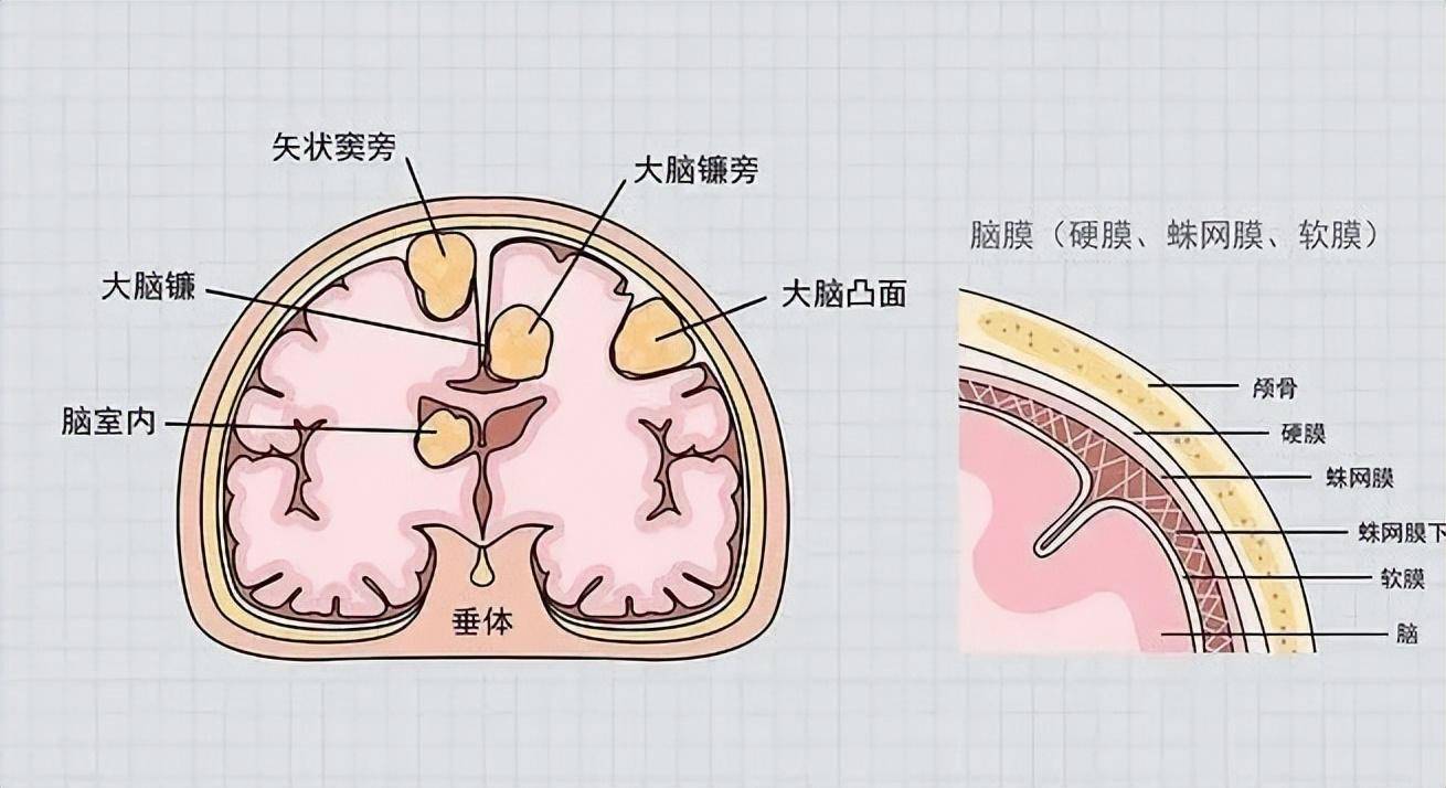 颅内肿瘤卡通图片图片