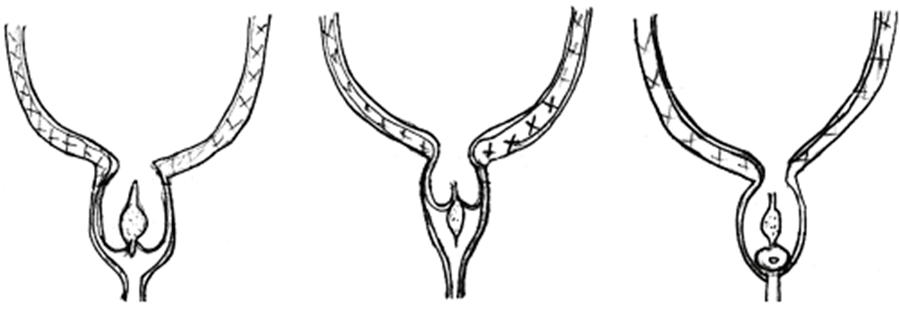 后尿道瓣膜 和 锁眼征_扩张_前列腺_膀胱