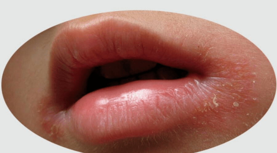 地图舌浅层的慢性拨脱性舌炎,又称游走性舌炎,慢性萎缩性舌炎,儿童多
