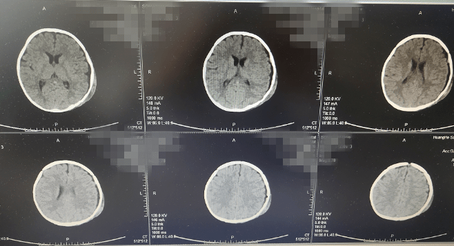脑出血ct报告单图片图片