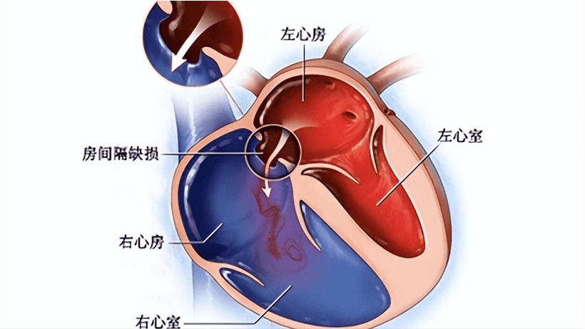 房间隔在心脏左右心房之间,正常人这个部分是完整的,左右心房是隔开的