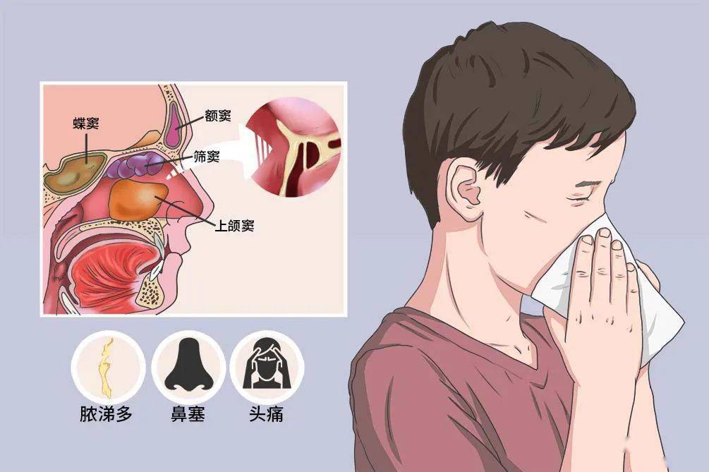 鼻塞内部图片图片