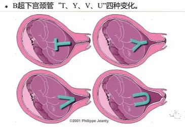 产妇刚出月子就带着宝宝回娘家