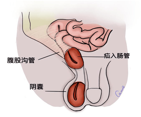 婴儿腹股沟疝图片