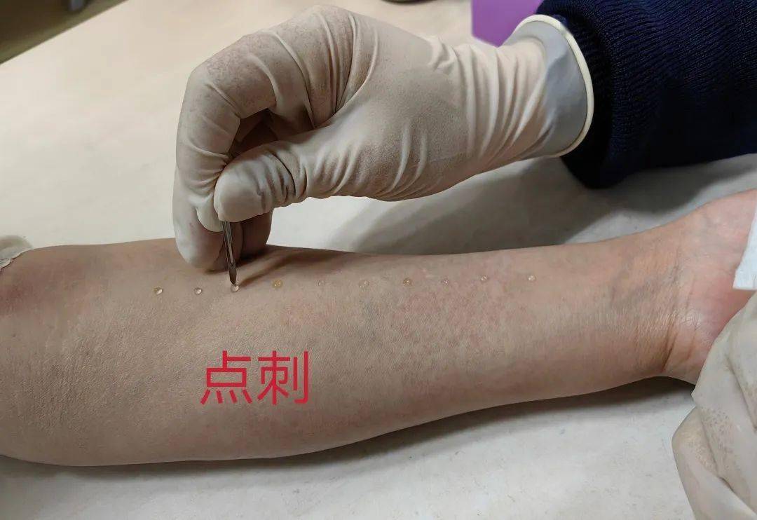 总ige和血清特异性ige检测;过敏原皮肤试验:皮肤点刺试验和皮内试验