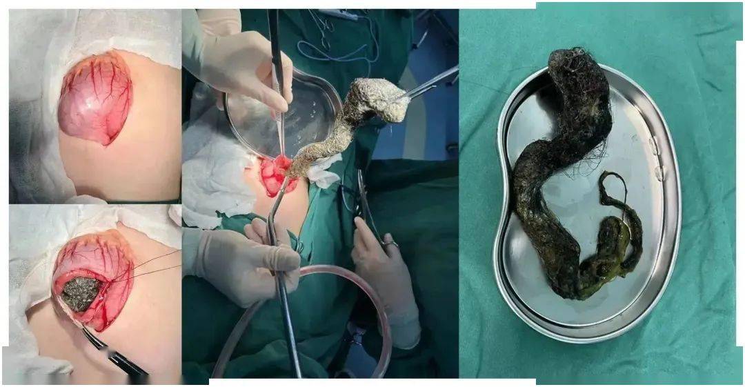 【典型案例】13岁女孩胃里"黑麻麻",市中心人民医院医生取出结块的