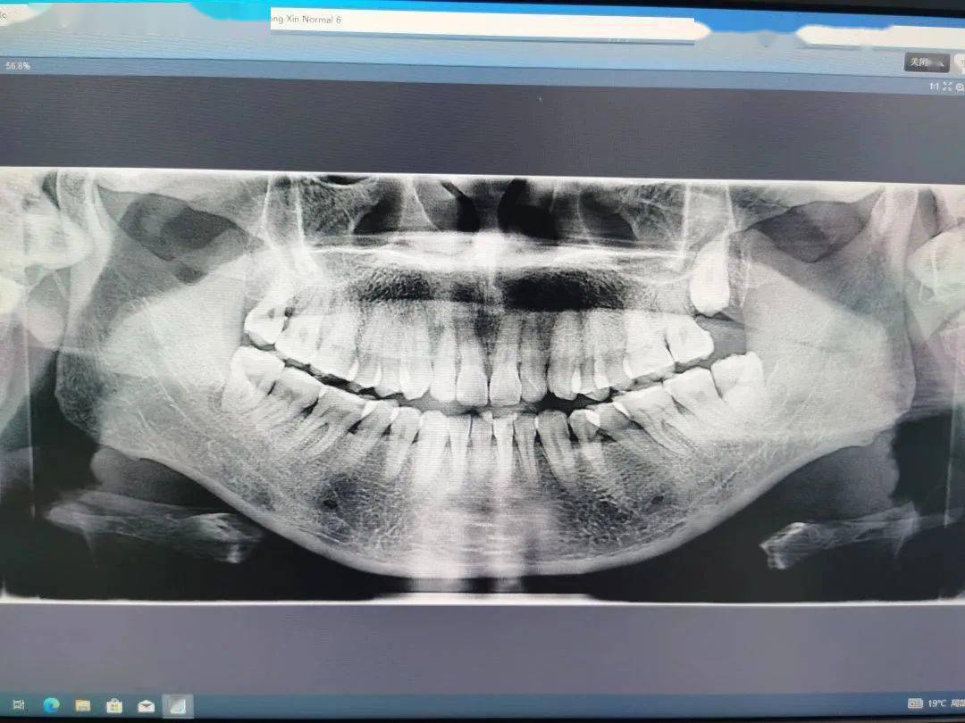 全景片的拍攝普蘭梅卡promax3d口腔ct的投入使用,為我院口腔診療水平