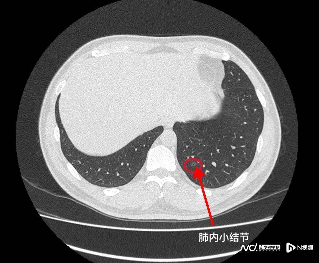 做了CT还要核磁共振？拍片做何筹办？专家提醒了