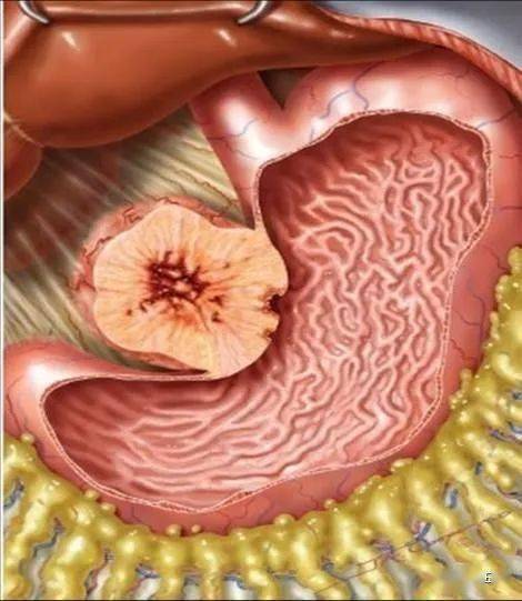 胃肿大的腹部图片图片