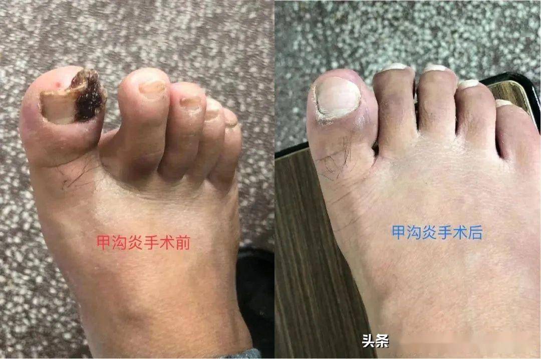 甲沟炎微创手术与传统手术比较,创伤小,不拔甲,不影响日常生活和工作