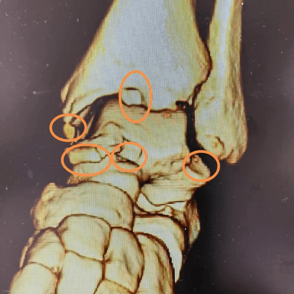 骨科医生:科学运动才行!