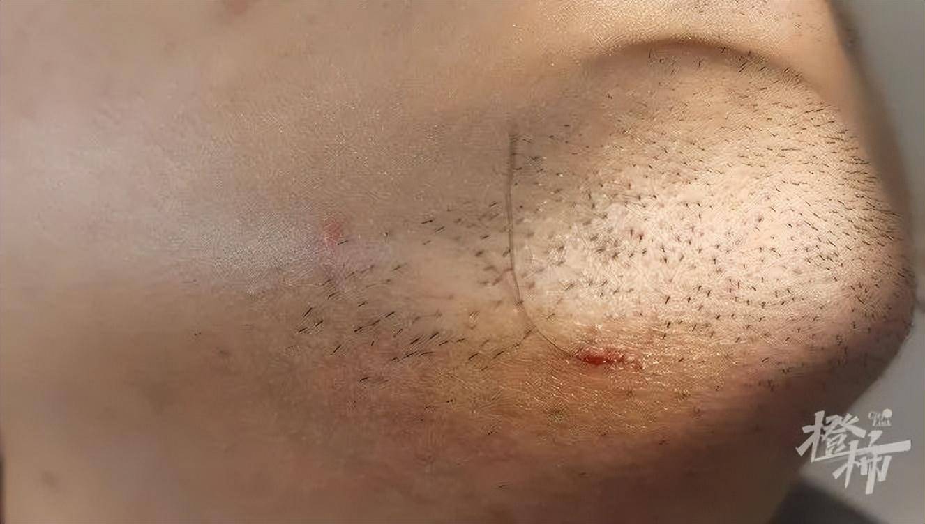 杭州小伙毛发钻进皮肤里,全球仅报道近40例_胡子_王进行_下巴