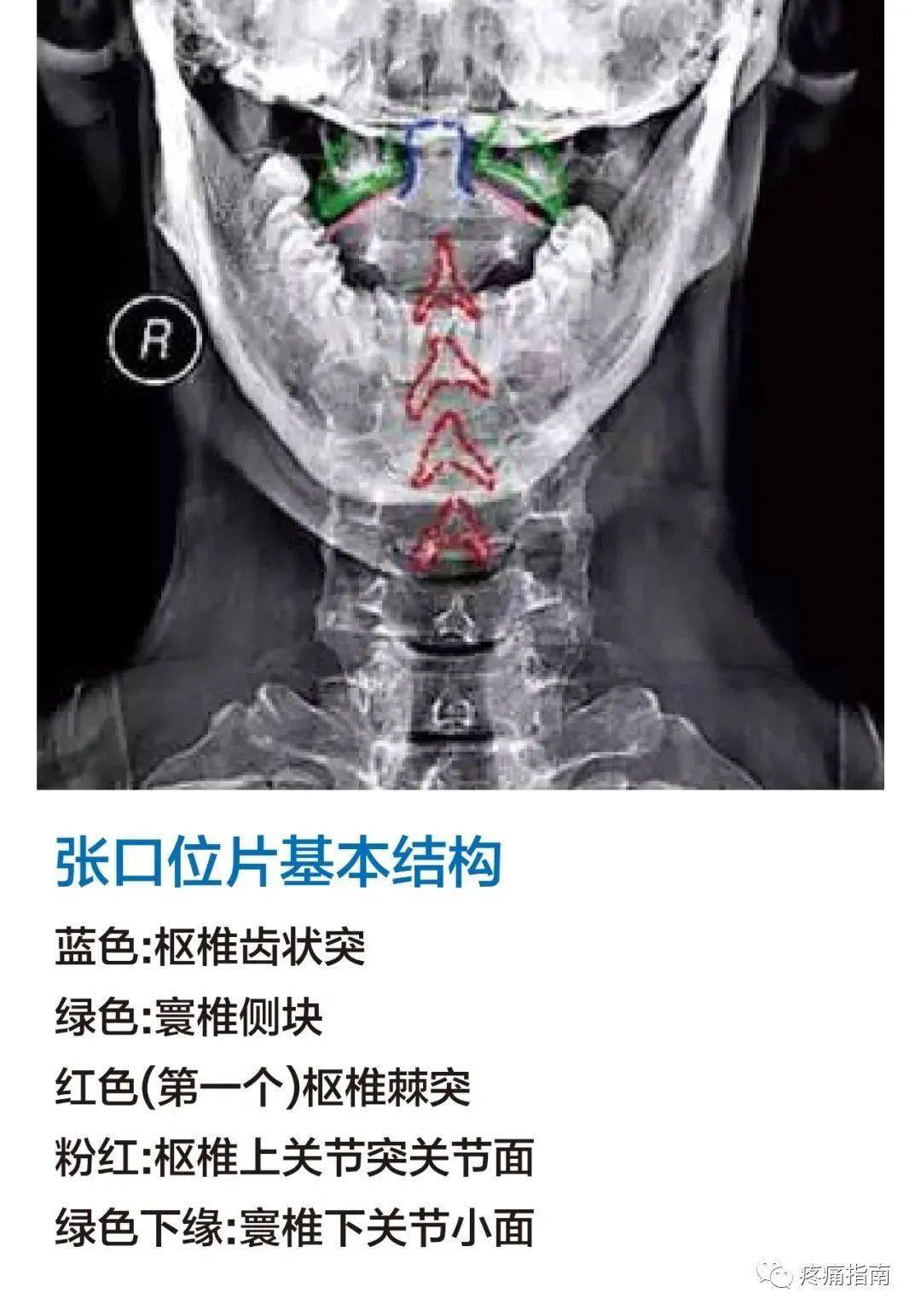 颈椎正位片图片解读图片