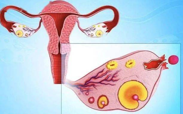 为卵巢有过多卵泡发育,导致病人血液浓缩,血浆外渗,出现胸腔积液,腹水