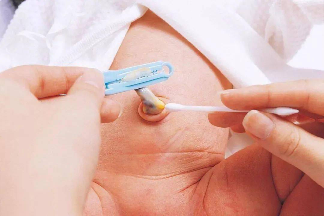 提醒各位新手爸爸妈妈,新生儿在脐带脱落过程中极易发生脐茸等问题