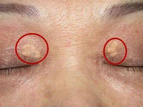 脸上3道横纹,心脏在喊"救命"!常按手上两个穴位,养护心脏!