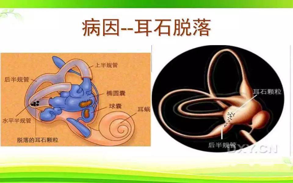 耳石症的病因,我们可以看到,内耳由前庭和耳蜗组成,前庭负责平衡功能