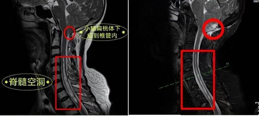 小脑扁桃体疝解剖图片