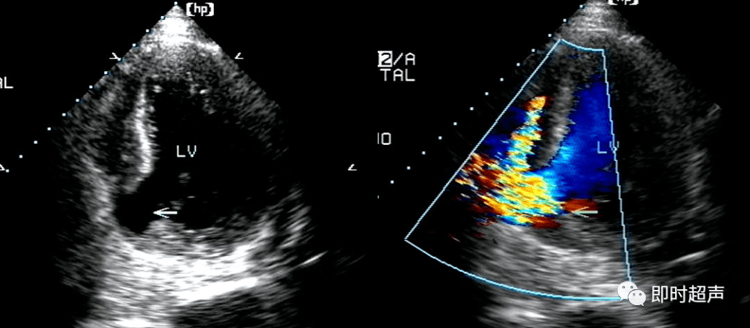 心肌梗死常见并发症超声诊断_二尖瓣_心动图_运动