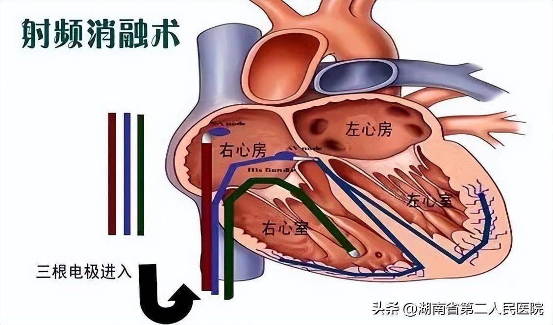 射频消融术原理示意图图片