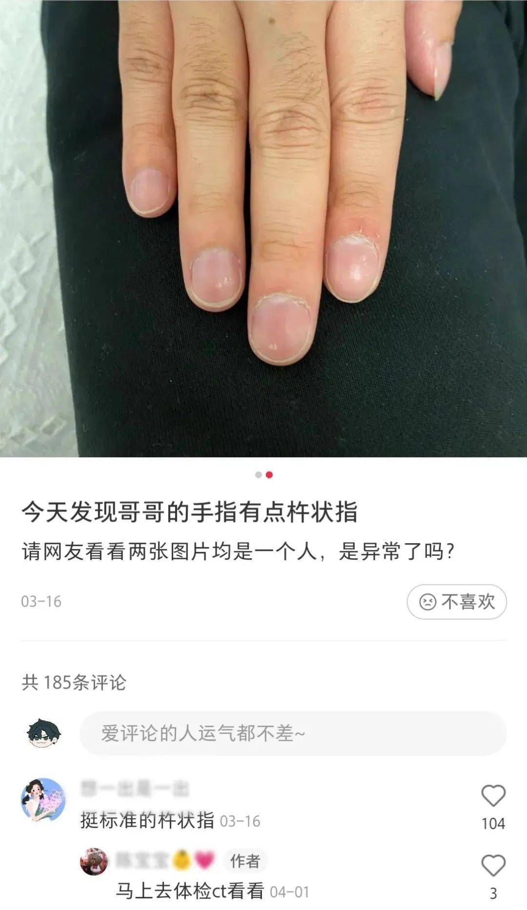 却无意确诊杵状指选美甲图片18:28没想到却是确诊了手指肌组织缺陷