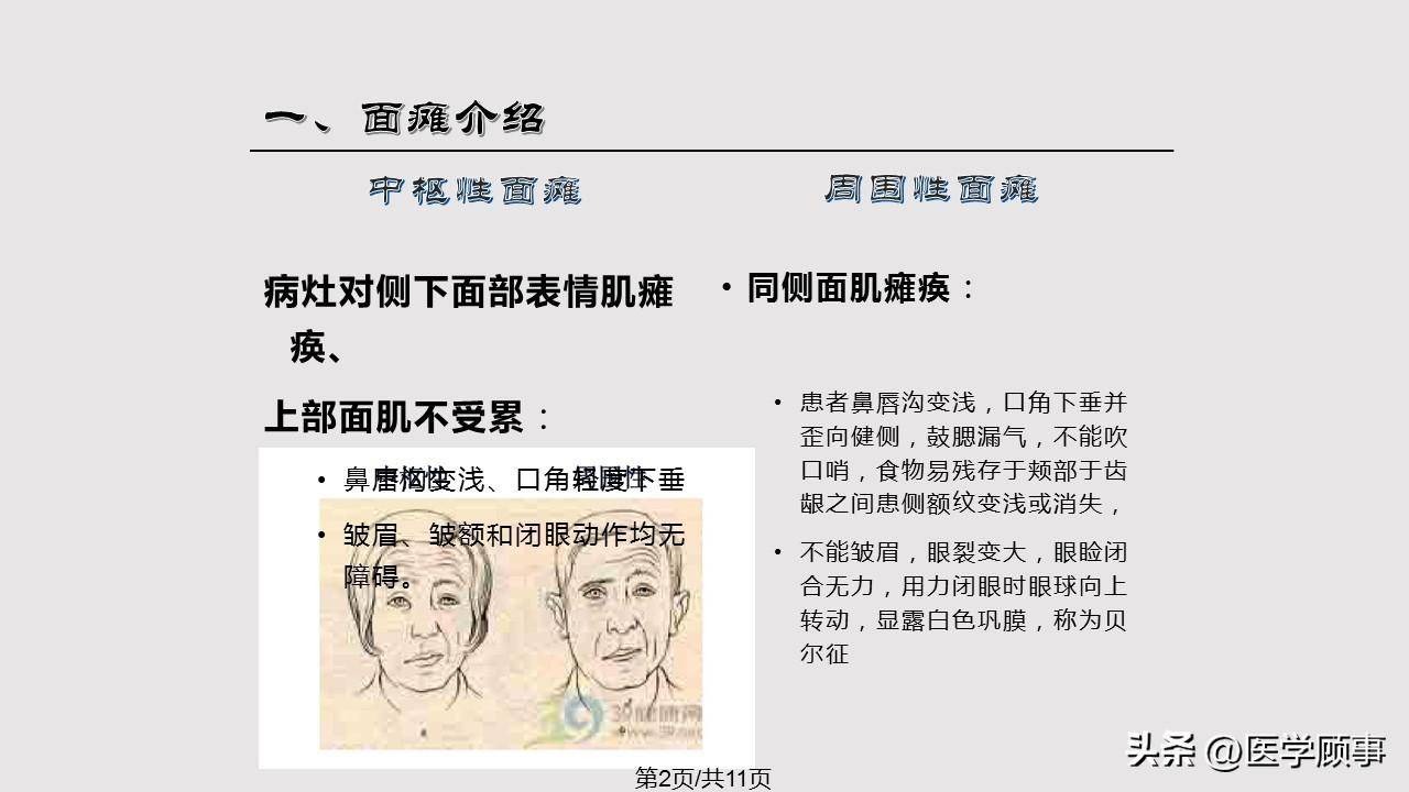 中枢性面瘫与周围性面瘫鉴别要点