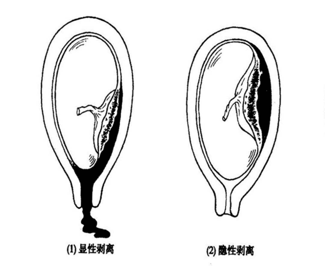 胎盘图片 后壁图片