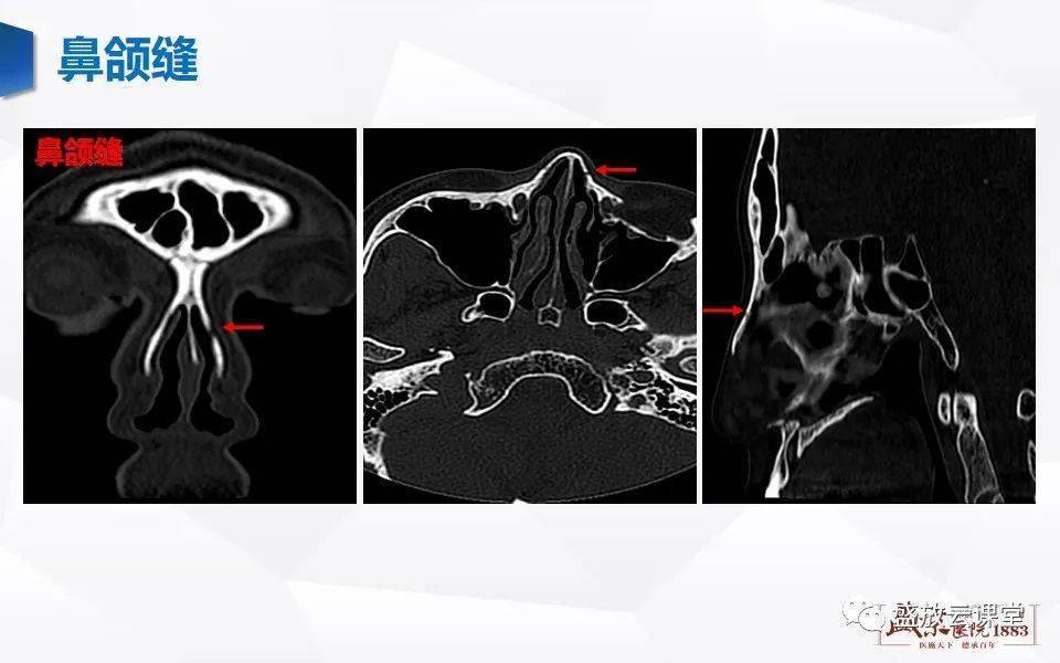 鼻骨正常ct解剖,變異與骨折_傳播_挑戰_平臺