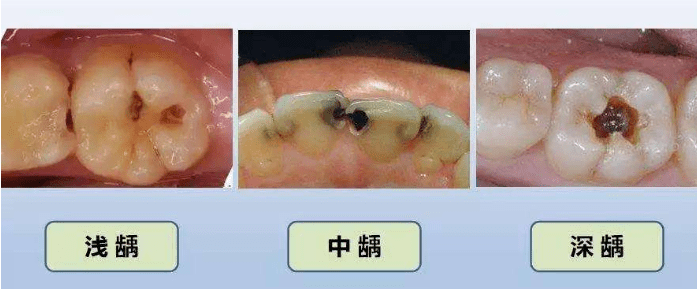 一文帶你看懂什麼是牙菌斑!_牙齒_危害_細菌