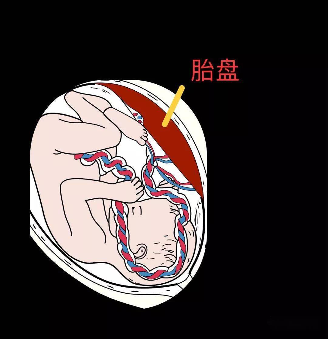 膜状胎盘图片