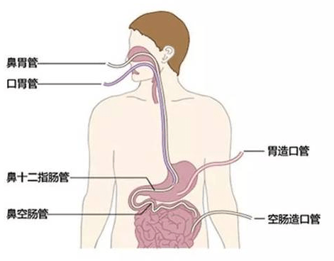 icu成功开展多例床旁盲插鼻肠管置管术