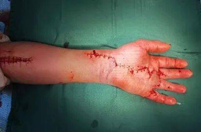 晋江一男子3指被电钻拉断!7小时营救,断指成功"复活"!