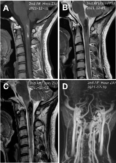 【病例分享】延颈髓髓内海绵状血管畸形一例(第二轮脊柱脊髓系列二十