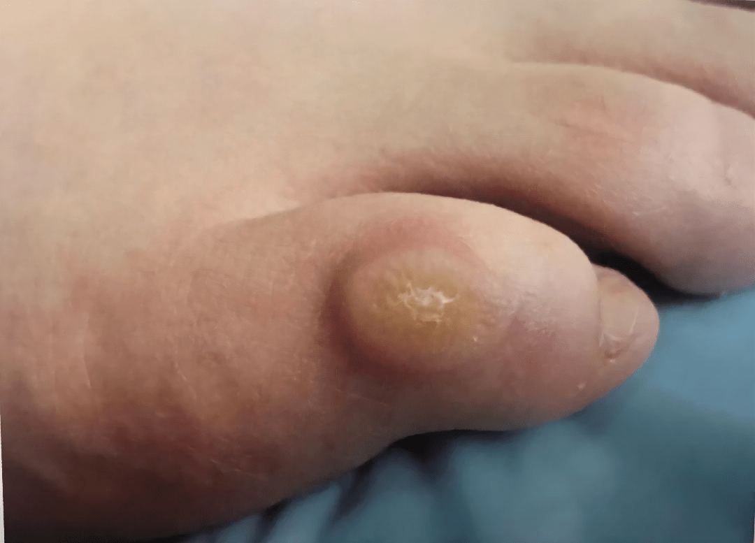 跖疣—图片来源:张建明《皮肤性病诊断图谱》病因:跖疣是由于人乳头瘤