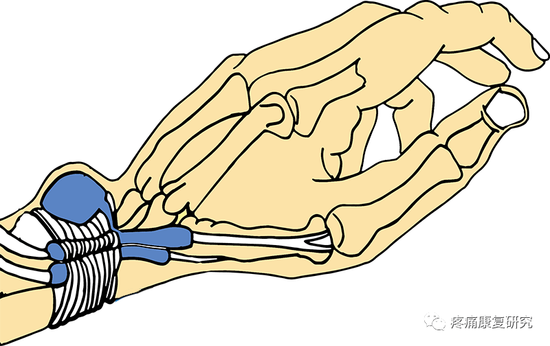 手腕处腱鞘囊肿的病因,症状,检查及治疗和预防