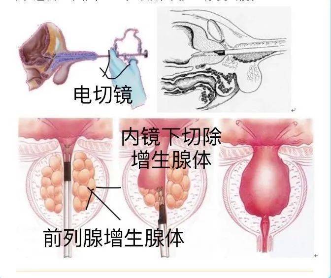 任黎刚主任医师当即建议吴先生做一次微创手术,同时解决前列腺增生与