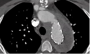 2)症状不典型agi,病例为复合手术后股动脉切口愈合不良,胸痛,无发热