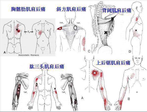 肩胛提肌扳机点图片