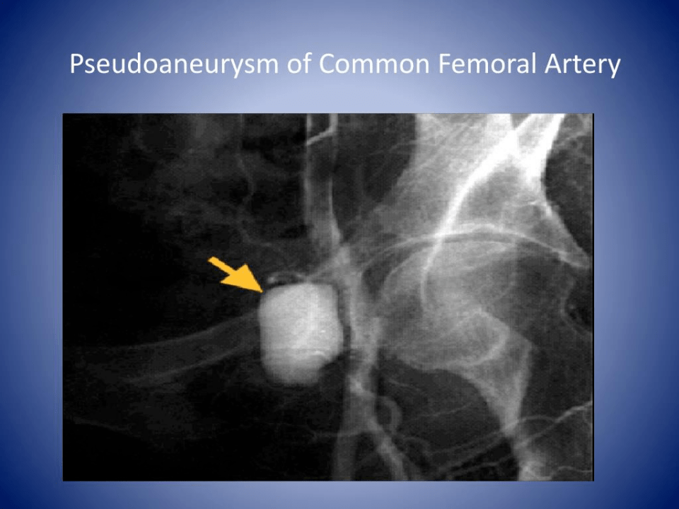 femoral artery图片