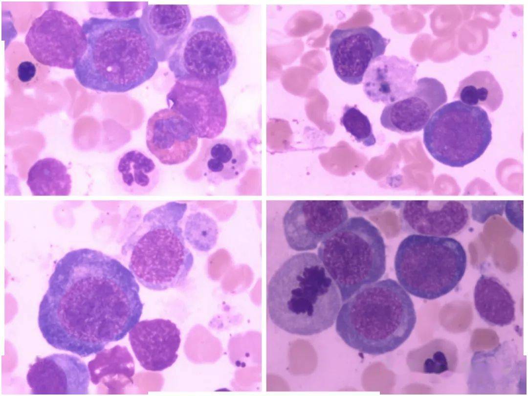 巨幼红细胞性贫血图片